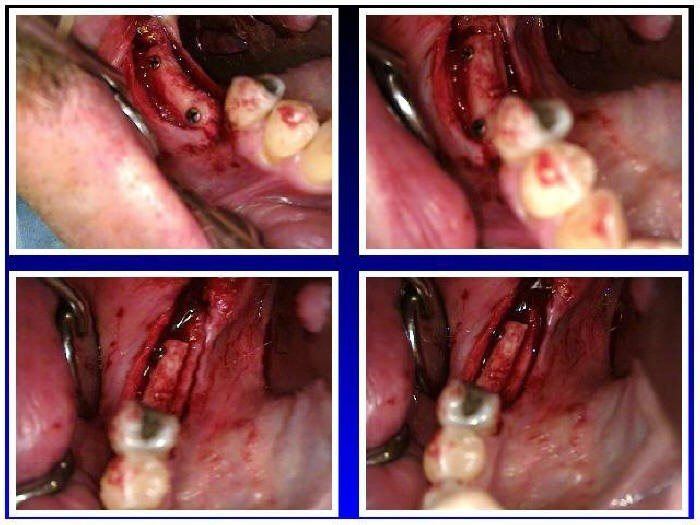 RAMUS GRAFT TO MANDIBLE