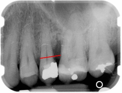 Radiographic Evidence