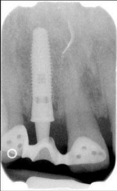 Post-Op Radiograph