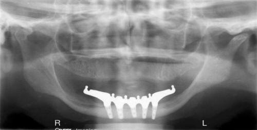 Post-Op Radiograph