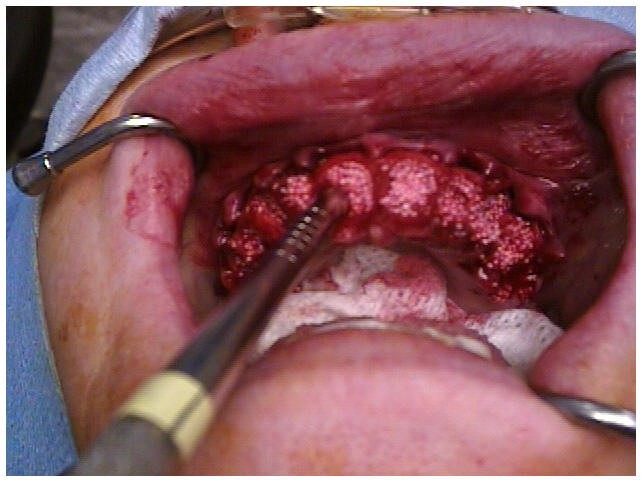 Alveoloplasty Compaction and HTR Grafting(1)