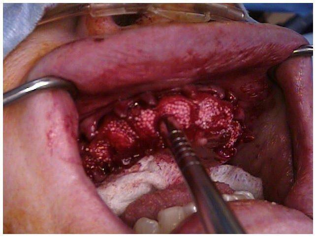 Alveoloplasty Compaction and HTR Grafting(2)