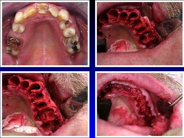 Alveoloplasty Compaction and HTR