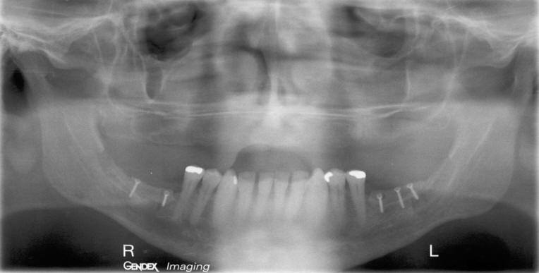 RAMUS GRAFT TO MANDIBLE