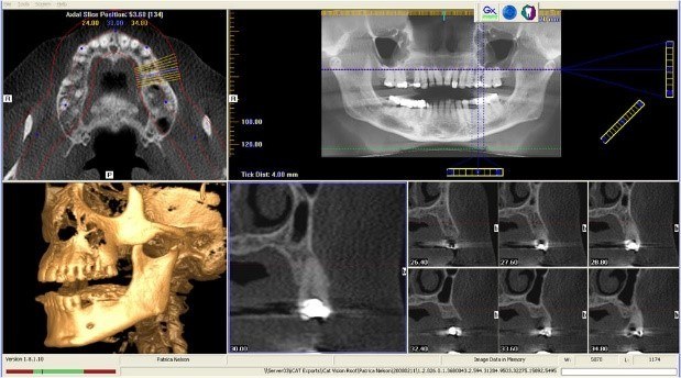 Radiographic Evidence