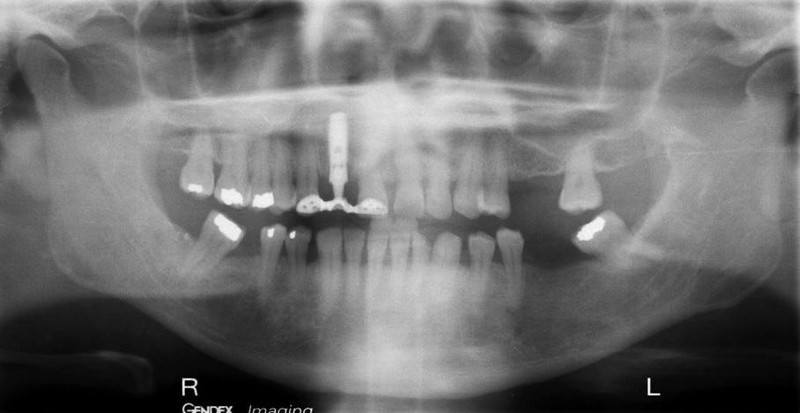 Panoramic Radiograph