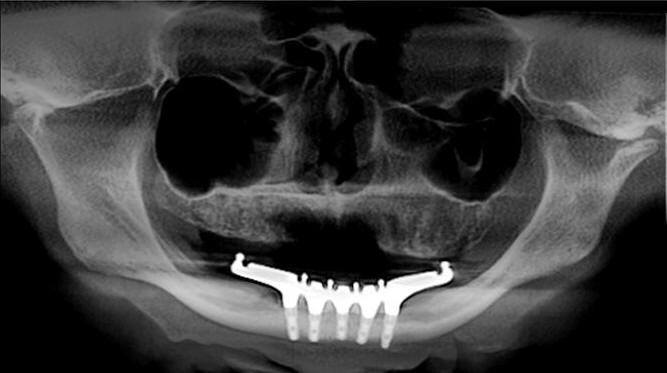 Post-Op Radiograph