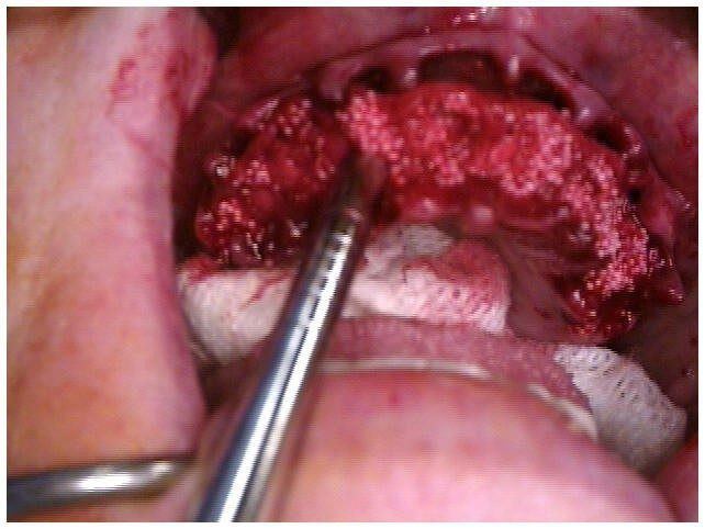 Alveoloplasty Compaction and HTR Grafting(1)