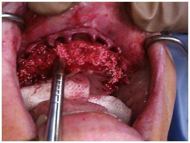 Alveoloplasty Compaction and HTR Grafting(2)