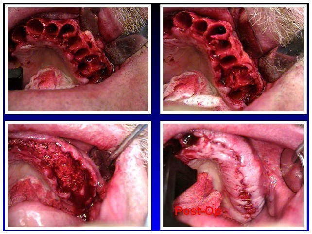 Alveoloplasty Compaction and HTR