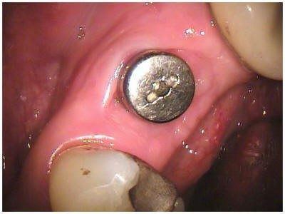 Healing Abutment