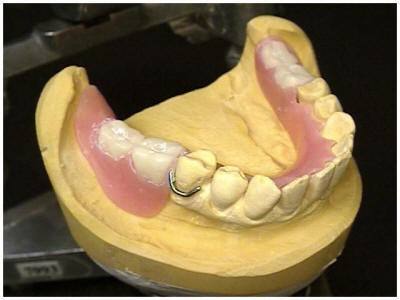 RAMUS GRAFT TO MANDIBLE