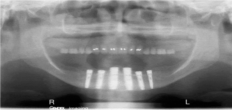 Acrylic Reconstruction6