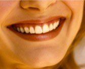 Bleaching & Teeth Whitening