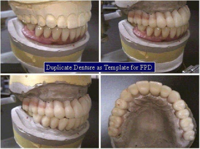 Ceramometal Reconstruction10