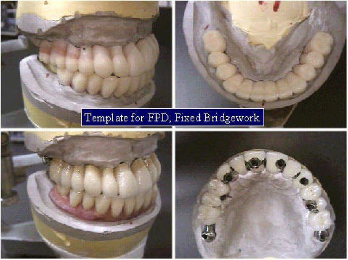 Ceramometal Reconstruction11