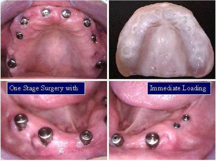 Ceramometal Reconstruction8