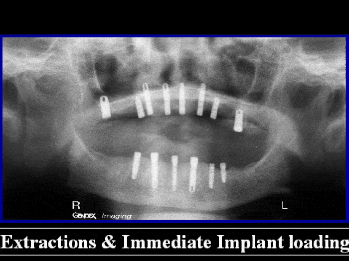 Ceramometal Reconstruction9