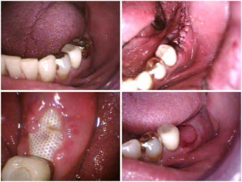 EXTRACTION, PRP AND GBR