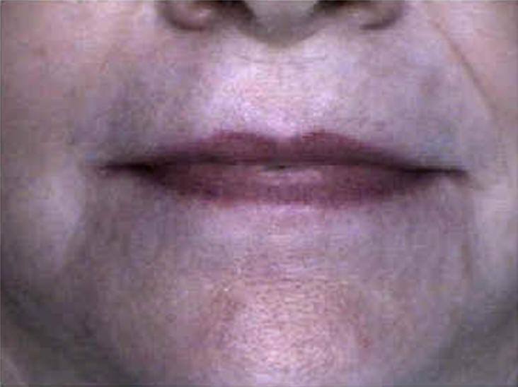 Personalized Cosmetic Dentures (2)
