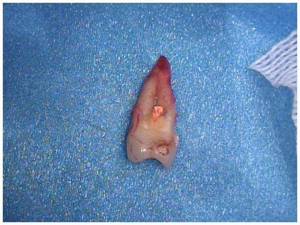 Removal of Tooth