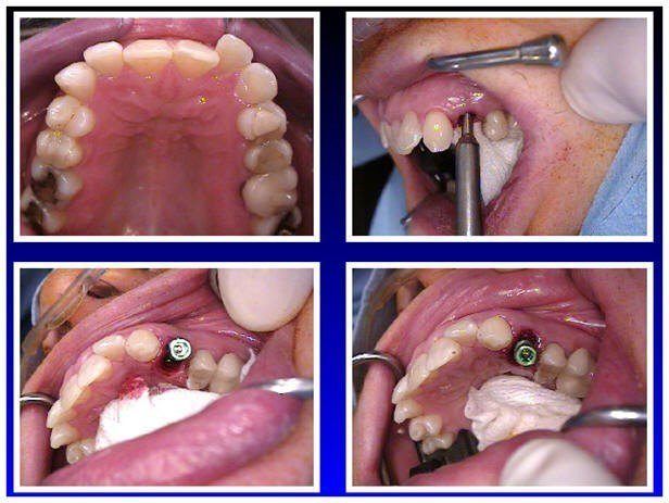 Extraction & Immediate Implant