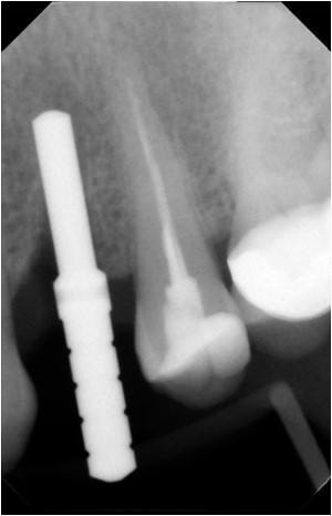 Immediate Implant (1)