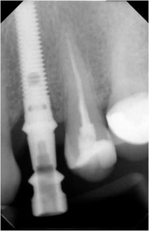 Immediate Implant (2)