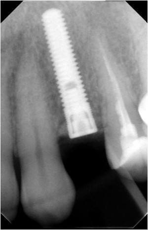  Immediate Implant (3)