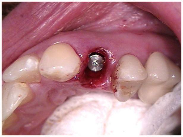 Immediate Implant Placement