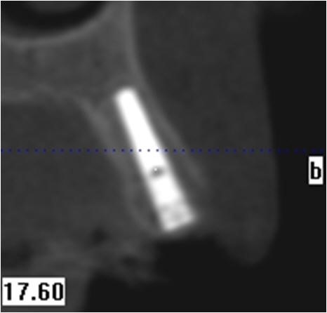 Post-Op Radiograph