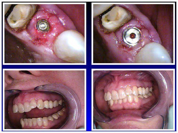 At Time of Membrane Removal