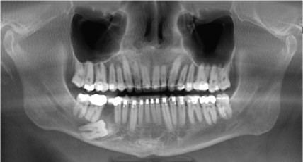  Pre-Operative Radiograph