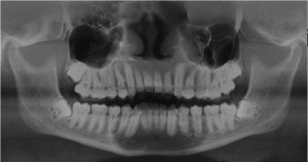 Pre-Operative Radiograph