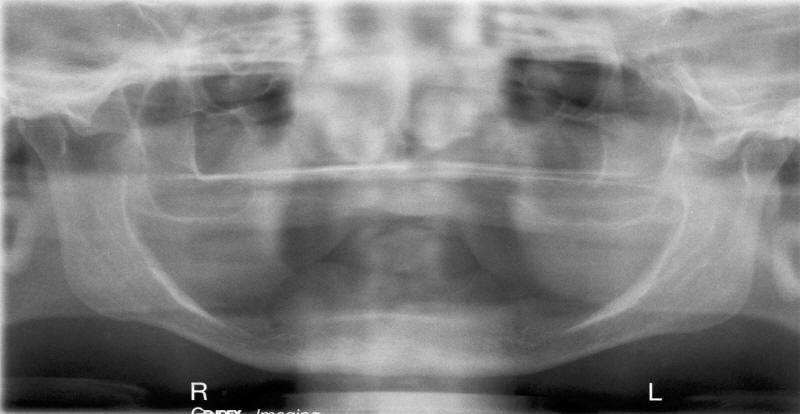 Pre-Operative Radiograph