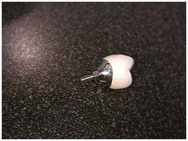 Custom Abutment