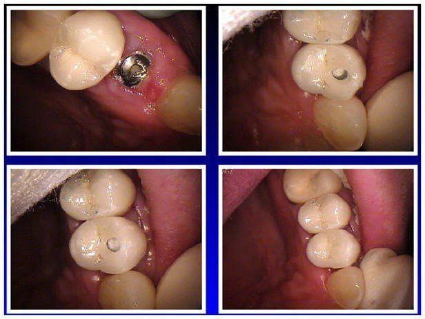 Custom Abutment