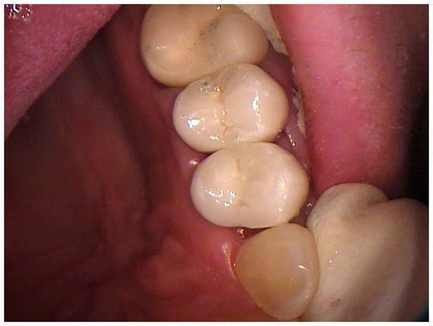 Custom Abutment