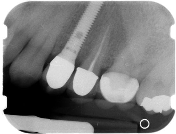 Time of Loading Bone