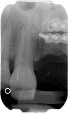 Alveolar distraction (1)