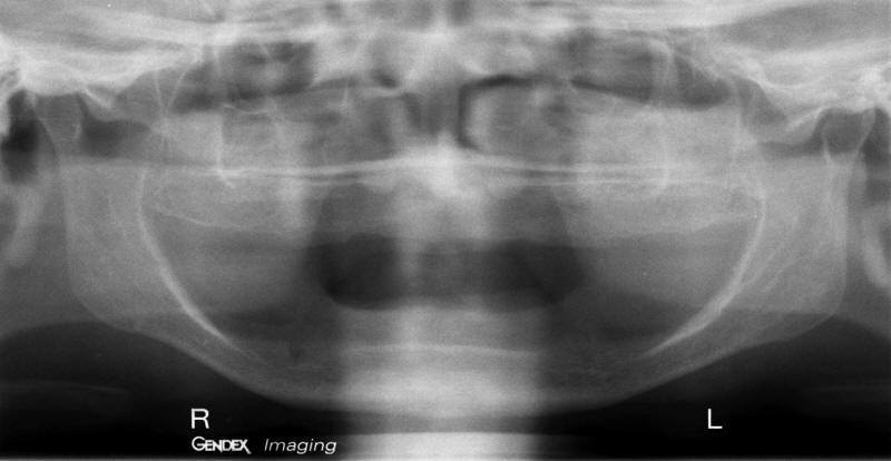 Pre-Operative Radiograph