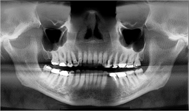 Initial Panoramic Radiograph