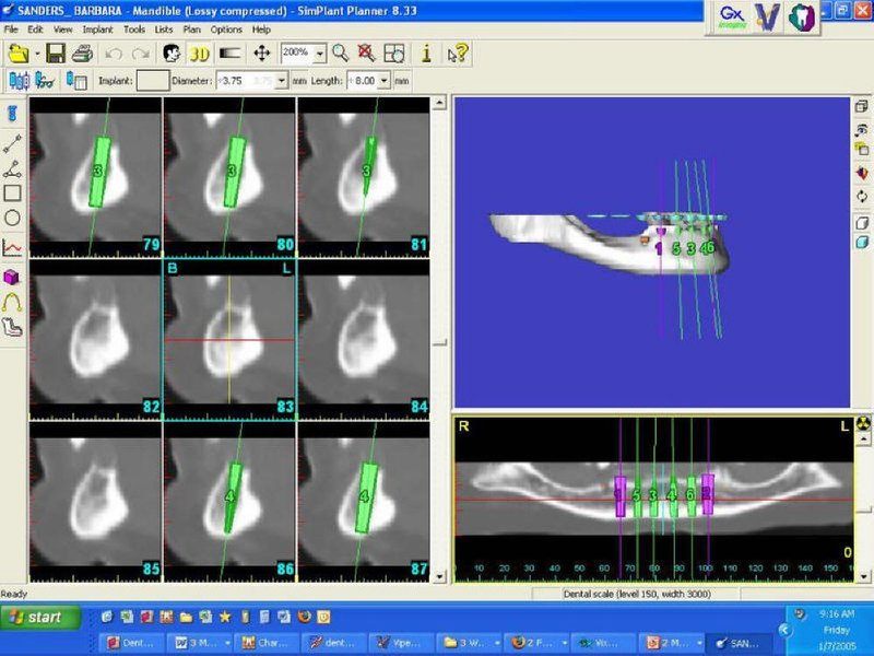 Pre-Operative Simplant