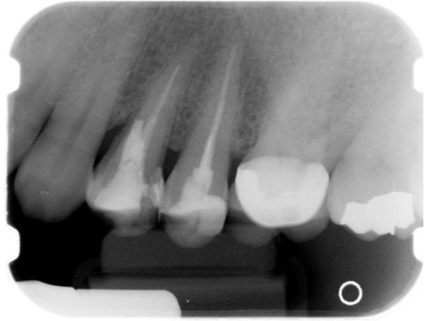 Initial Radiograph