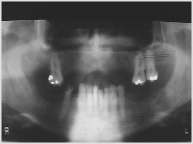 Pre-Operative Radiograph