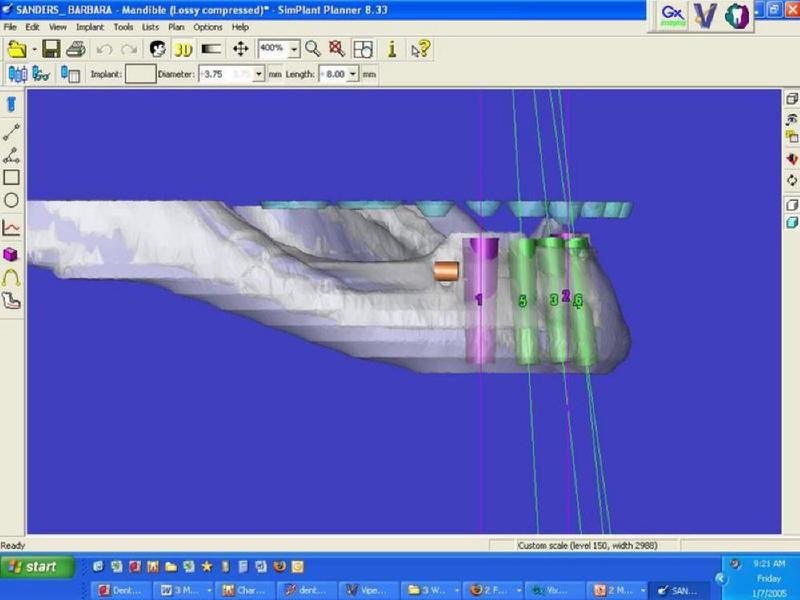 Pre-Operative Simplant 3D Model