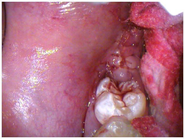  Tissue Closure