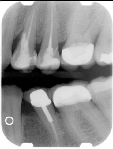 Initial Radiograph