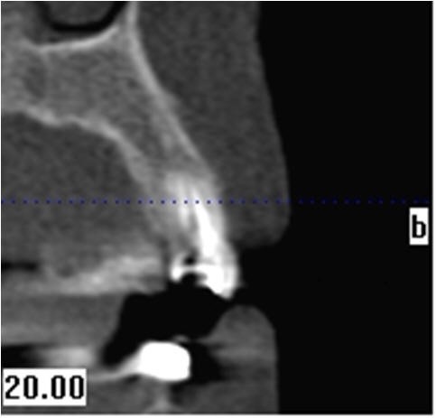 Initial Radiograph Cross