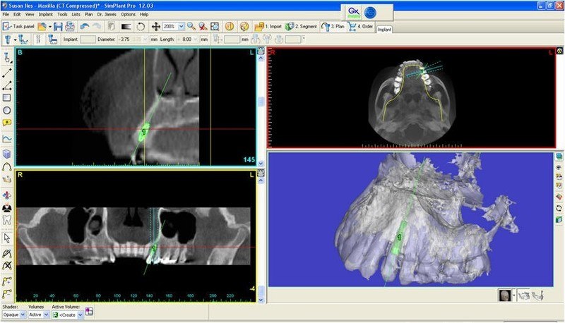 CBCT scan